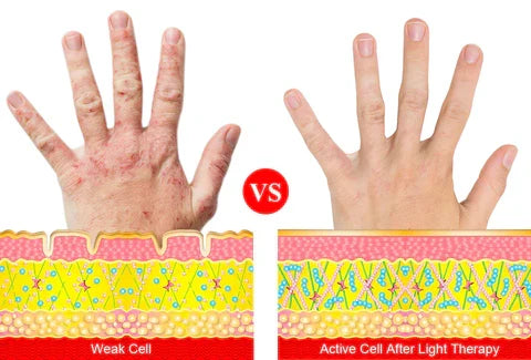 ArthroGlow: Handterapihandskar mot artrit för förbättrad rörlighet.