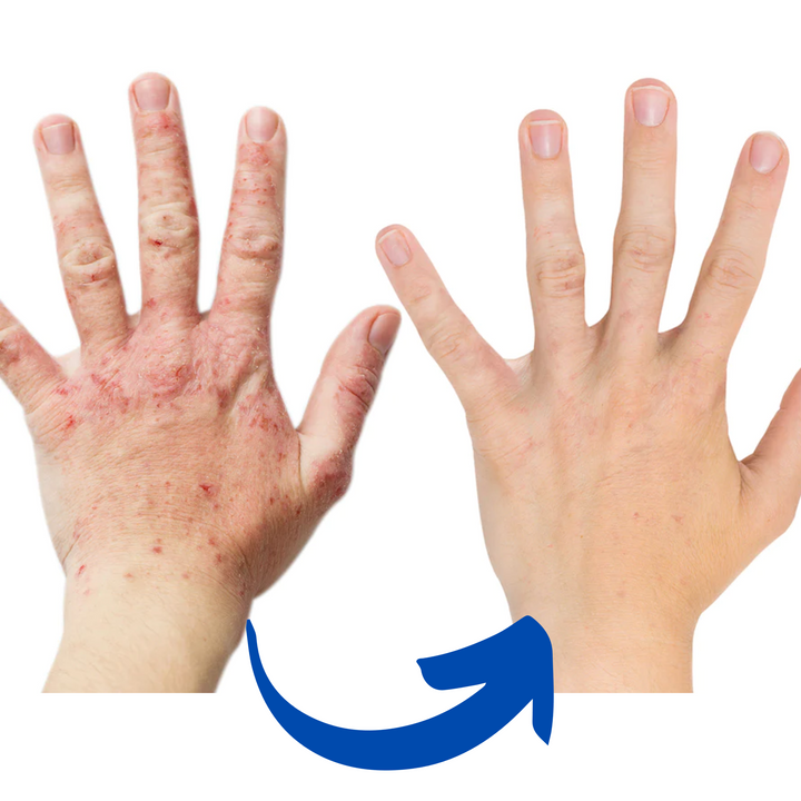 Smärtlindring vid artrit med ArthroGlow handskar. Främjar cellförnyelse.